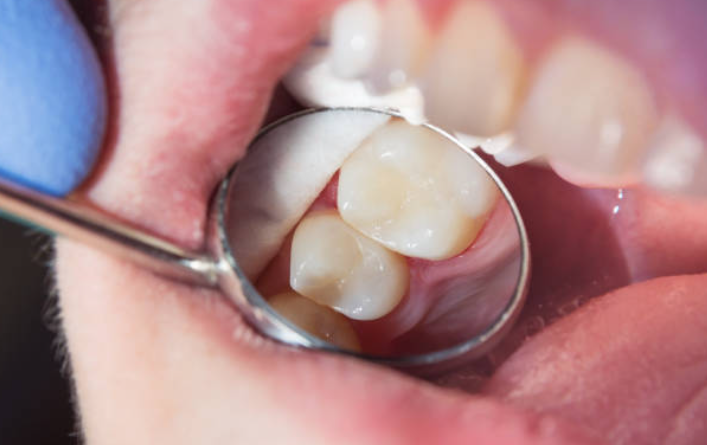 A photo of a tooth after a dental filling