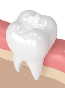 Photo of a dental filling