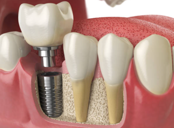 A mockup example of how a Dental Implant works