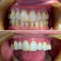 Nanton Dental Pinhole Treatment