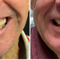 Cosmetic Smile Rejuvenation treatment at Nanton Dental