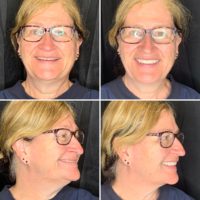 Smile Rejuvenation / Makeover treatment at Nanton Dental