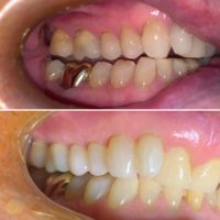 Pinhole treatment used at Nanton Dental