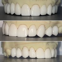 Mockup of a Smile Rejuvenation example at Nanton Dental