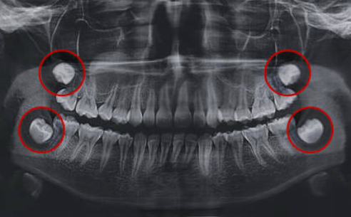 Image of an xray showing wisdom teeth