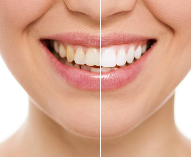 Image of Teeth Whitening at Nanton Dental