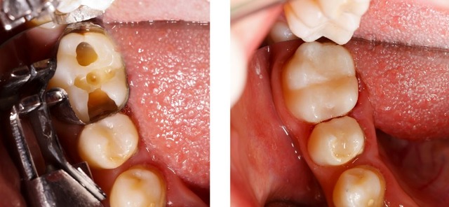 Dental Filling Example