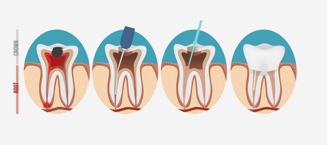 Root Canal Diagraphm